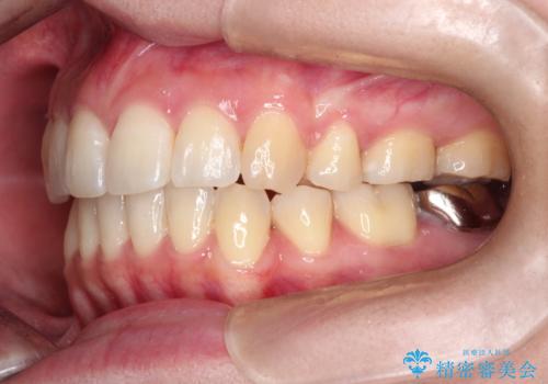 【審美ワイヤー装置】前歯を噛ませたいの治療後