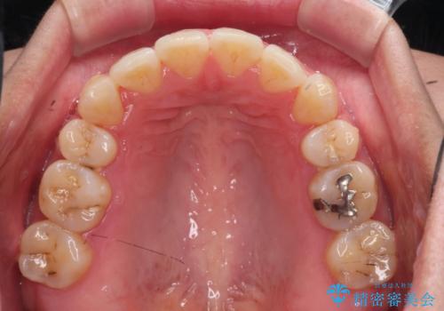 【審美ワイヤー装置】前歯を噛ませたいの治療後