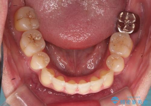 【審美ワイヤー装置】前歯を噛ませたいの治療後