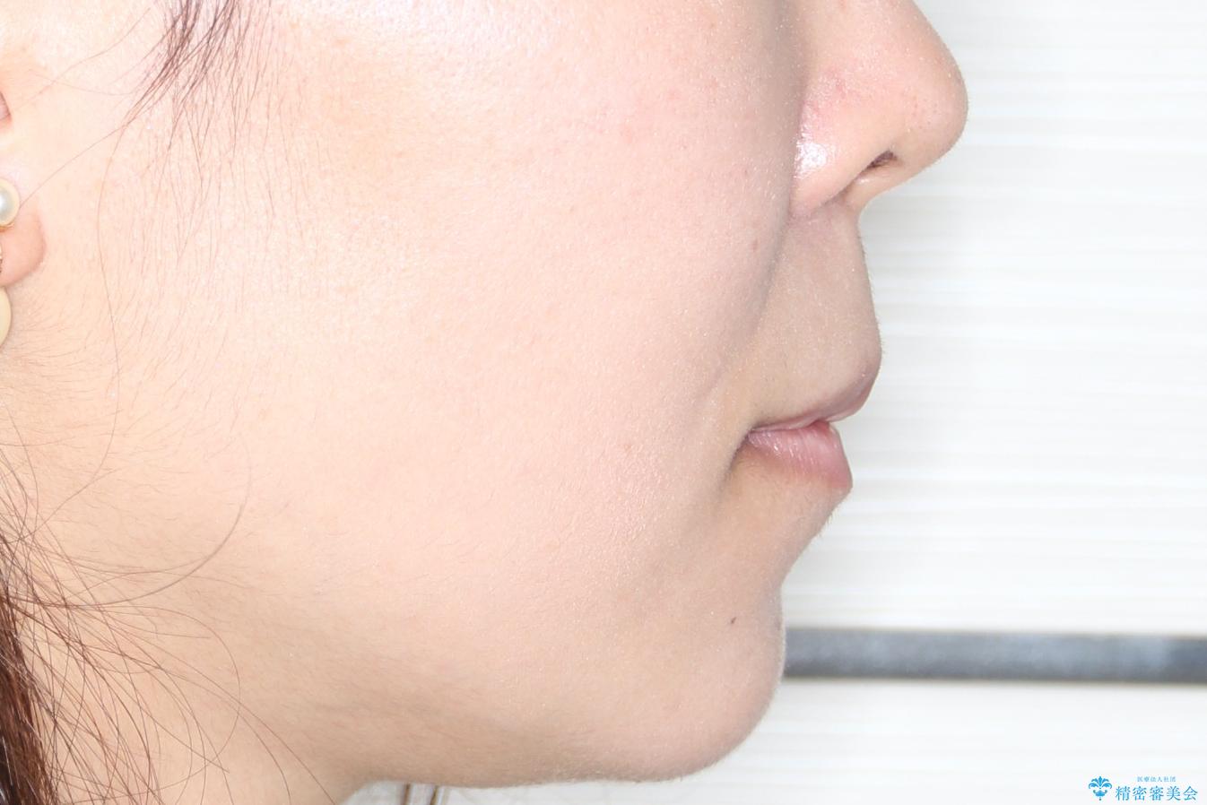 【審美ワイヤー装置】前歯を噛ませたいの治療後(顔貌)