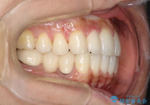 【インビザライン】矮小歯を有する方の矯正治療の治療後