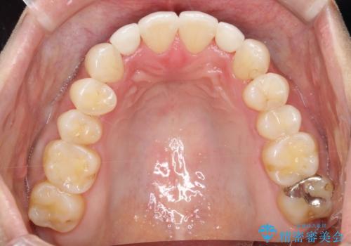 【インビザライン】矮小歯を有する方の矯正治療の治療後
