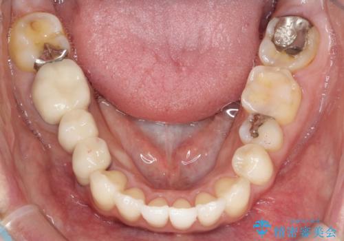 【インビザライン】矮小歯を有する方の矯正治療の治療後