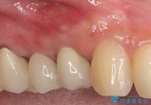 【歯根端切除術】根っこの治療をしたが、また腫れてきた。の治療後