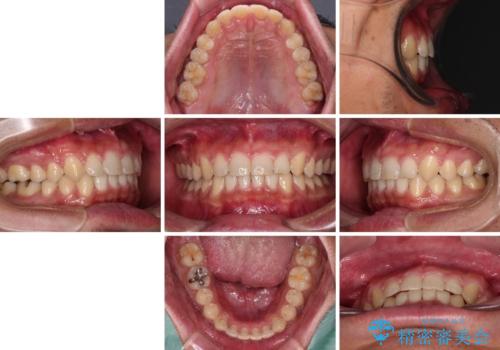 深い咬み合わせと隙間の空いた歯列をワイヤー矯正で改善の治療後