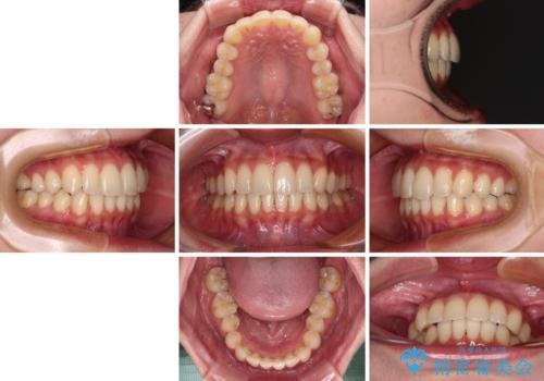 【モニター】インビザラインをしっかり使って短期間矯正治療の治療後