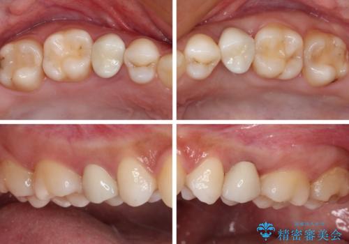 抜歯と言われた歯を残したい 部分矯正と外科処置を用いた補綴治療の治療後