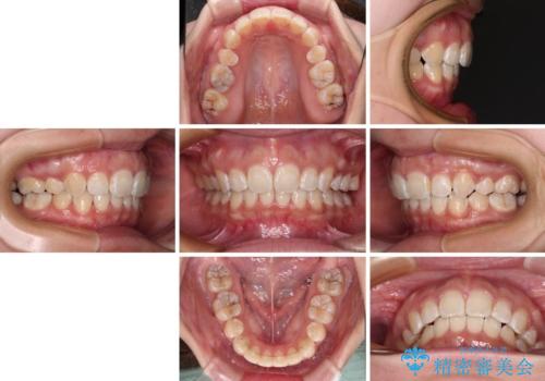 上顎前突による口元の突出感　強く深い咬合をワイヤー矯正で改善していくの治療後