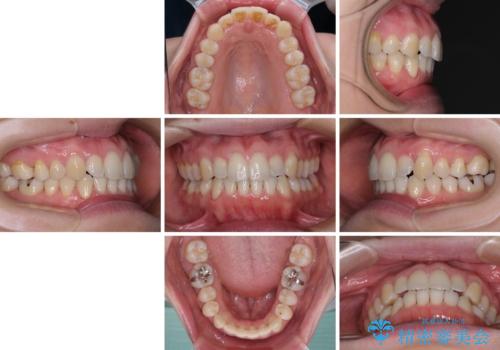 受け口傾向の歯並びをインビザラインで改善の治療後