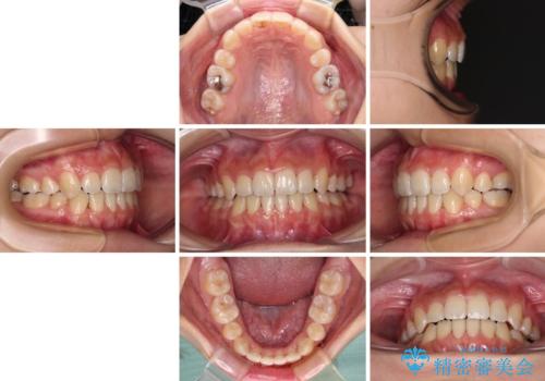 デコボコと八重歯の目立つ前歯 ワイヤー装置による抜歯矯正の治療後