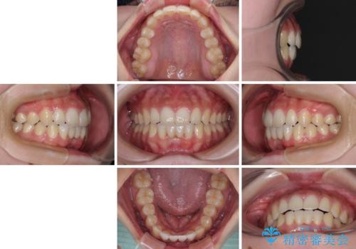 乳歯残存と欠損の前歯 矯正治療とオールセラミックブリッジ治療の治療後