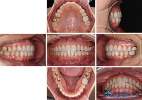 ちょっとしたデコボコをしっかりと改善したい インビザライン矯正の治療後
