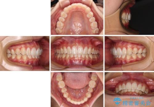 深い咬み合わせで前方に煽られた前歯 高校生のインビザライン矯正治療の治療後