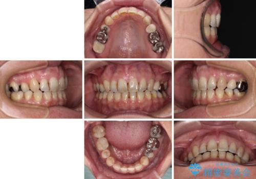 閉じにく口元と欠損歯列　ワイヤー装置の抜歯矯正の治療後