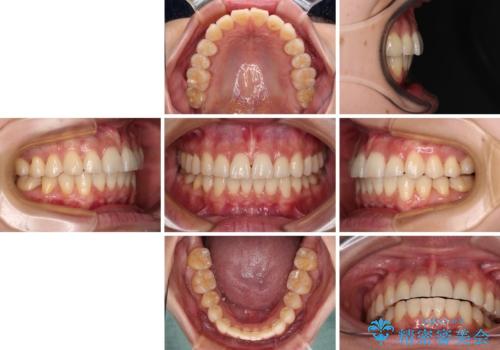 前にずれた咬み合わせをワイヤー装置でしっかりと改善の治療後