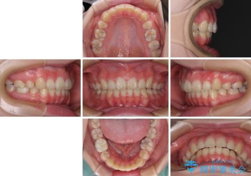 目立たない装置で出っ歯を治したい ハーフリンガル矯正の治療後