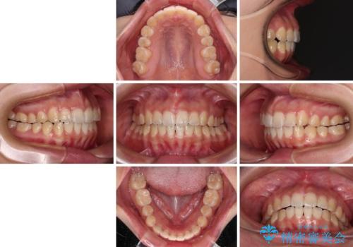【モニター】カリエールディスタライザーとインビザラインを用いた奥歯の咬み合わせ改善の治療後