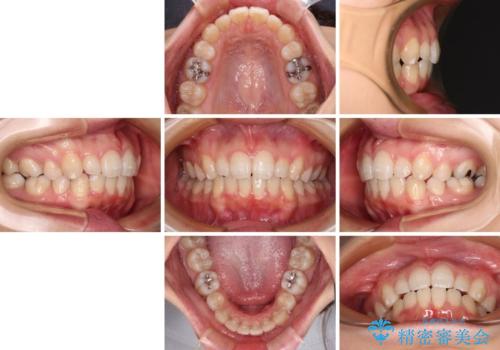 抜歯矯正の後戻り インビザライン・ライトによる矯正治療の治療後