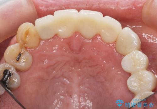 ぐらつく前歯 ブリッジ治療の治療後