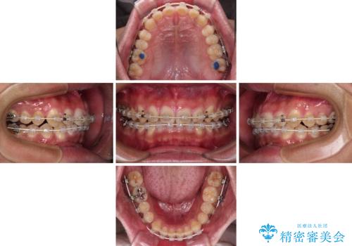 深い咬み合わせと隙間の空いた歯列をワイヤー矯正で改善の治療中