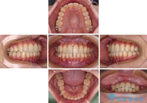 【モニター】インビザラインをしっかり使って短期間矯正治療の治療中