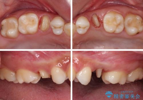 抜歯と言われた歯を残したい 部分矯正と外科処置を用いた補綴治療の治療中