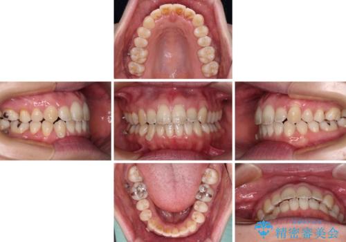 受け口傾向の歯並びをインビザラインで改善の治療中