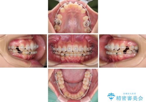 デコボコと八重歯の目立つ前歯　ワイヤー装置による抜歯矯正の治療中