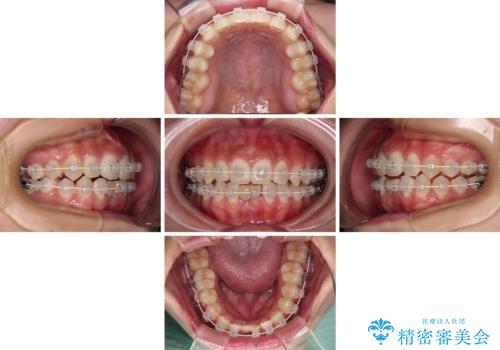 乳歯残存と欠損の前歯 矯正治療とオールセラミックブリッジ治療の治療中