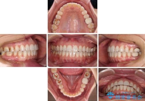 ちょっとしたデコボコをしっかりと改善したい インビザライン矯正の治療中