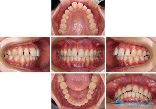 深い咬み合わせで前方に煽られた前歯 高校生のインビザライン矯正治療の治療中