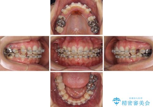 閉じにく口元と欠損歯列 ワイヤー装置の抜歯矯正の治療中