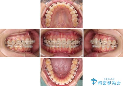 前にずれた咬み合わせをワイヤー装置でしっかりと改善の治療中