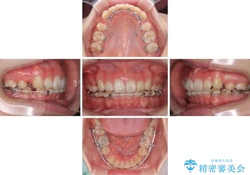 目立たない装置で出っ歯を治したい ハーフリンガル矯正の治療中