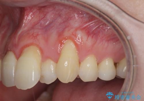 目立つ八重歯の歯ぐきのさがり  根面被覆による改善の治療前