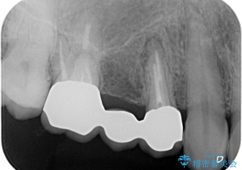 【歯根端切除術】根っこの治療をしたが、また腫れてきた。の治療前