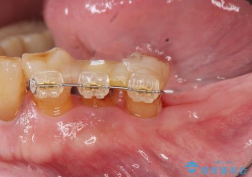 [ 歯周病治療 ] 小矯正を含むインプラント補綴・歯周補綴の治療後