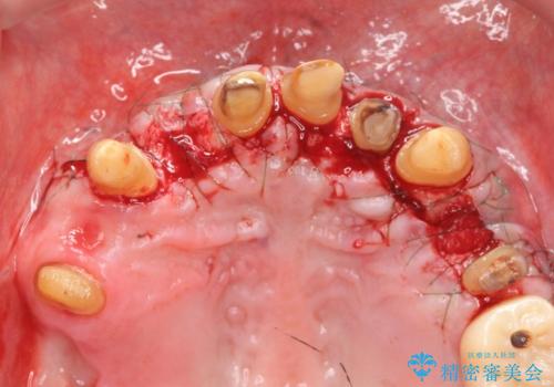 歯周病治療を伴う前歯審美セラミック治療の治療後