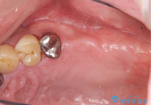 [ 歯周病治療 ] 小矯正を含むインプラント補綴・歯周補綴の治療前