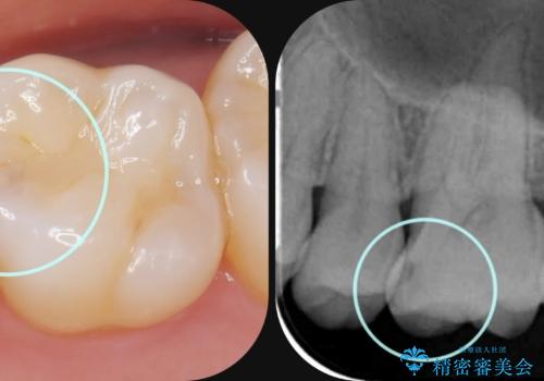 虫歯の発生を初期段階で発見　ゴールドインレー修復
