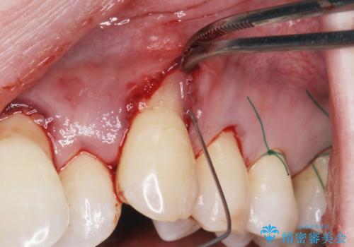 目立つ八重歯の歯ぐきのさがり  根面被覆による改善の治療中