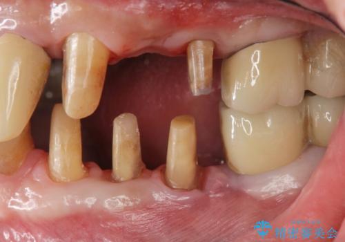 [ 歯周病治療 ]　小矯正を含むインプラント補綴・歯周補綴の治療中