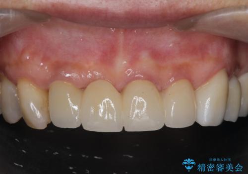 ぐらつく前歯 ブリッジ治療の症例 治療後
