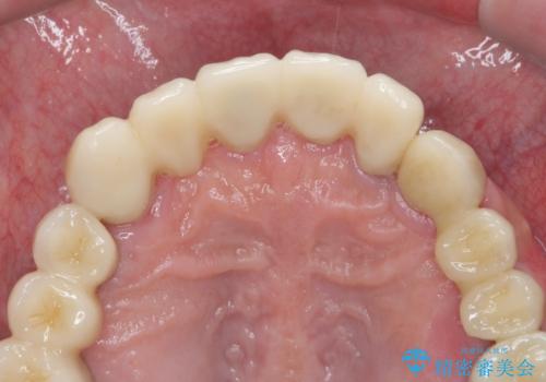 歯周病治療を伴う前歯審美セラミック治療の治療後