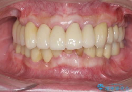 歯周病治療を伴う前歯審美セラミック治療の治療後