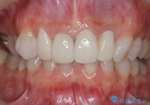 [ 前歯のセラミック治療 ]   前歯を自然にしたいの治療後