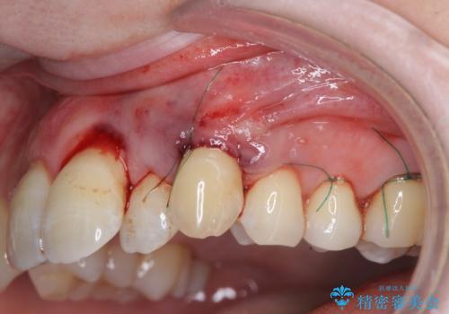 目立つ八重歯の歯ぐきのさがり  根面被覆による改善の治療中