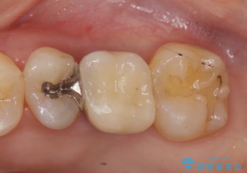 他院での矯正治療中 ソケットリフトを伴うインプラント治療依頼の治療後