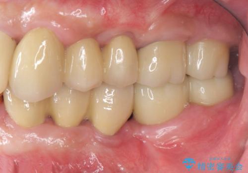 [ 歯周病治療 ]　小矯正を含むインプラント補綴・歯周補綴の治療後