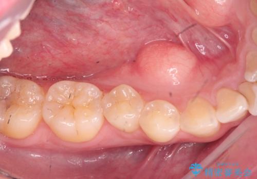 [ 下顎骨隆起の切除 ] 舌のスペースが狭く話しづらいの症例 治療前